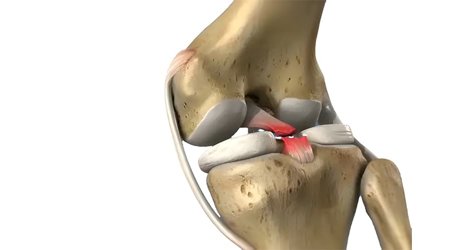 Rotura del ligamento cruzado anterior